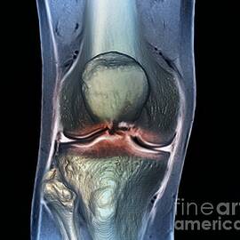 Healthy Knee, Ct Scan