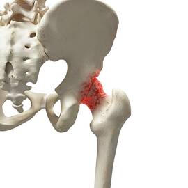 Arthritis In The Hip
