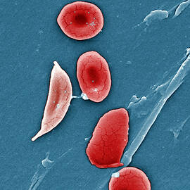 Sickle Cell Anemia, Human Rbcs, Sem by Science Source