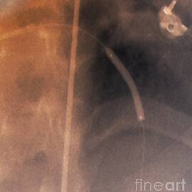 Coronary Stenosis Treatment, X-ray