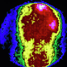 Immunoscintigram Showing Secondary Cancer