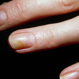 Tinea Fungal Infection Of A Woman's Fingernail by Science Photo Library