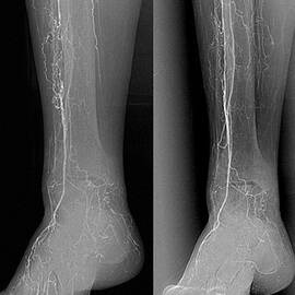 Treatment For Blocked Leg Arteries by Science Photo Library
