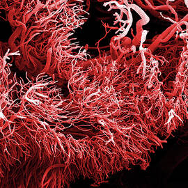 Tumour Blood Vessels by Science Photo Library