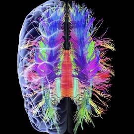 White matter fibres and brain, artwork by Science Photo Library