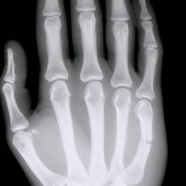 X-ray Of Broken Bone In Right Hand by Science Photo Library
