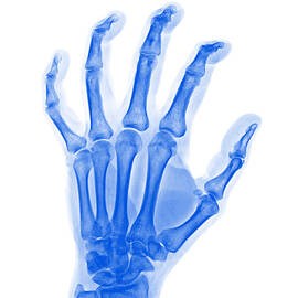 Arthritic Hand, X-ray