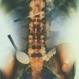 Coloured X-ray Of Spoon And Blade In Intestine