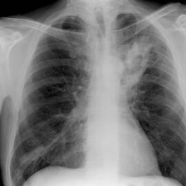 Lung Abscess, X-ray