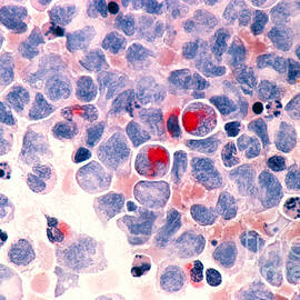Myelocytic Leukemia by Science Source