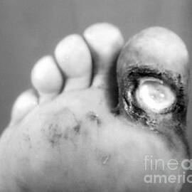 Syphilis Ulcer by Science Source