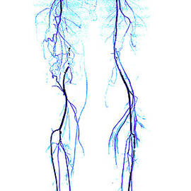 Atherosclerosis, Ct Angiogram by Living Art Enterprises