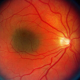 Nevus In The Retina by Science Source