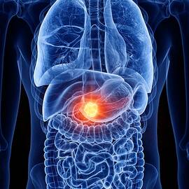 Pancreas Cancer