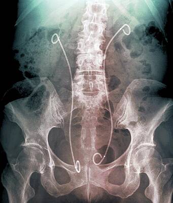 Wall Art - Photograph - 'artificial Kidney Ureters #1 by Science Photo Library