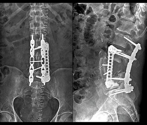 Wall Art - Photograph - Implants Following Spinal Surgery #1 by Science Photo Library