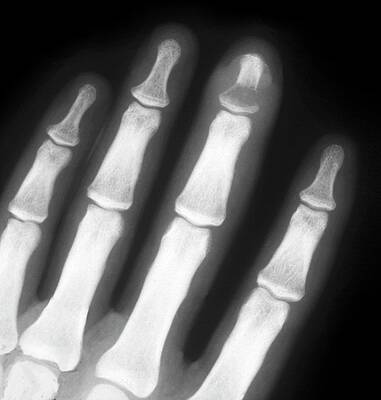 Wall Art - Photograph - Inflamed Bone Of The Finger #1 by Science Photo Library