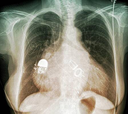 Wall Art - Photograph - Pacemaker And Artificial Heart Valves #1 by Science Photo Library