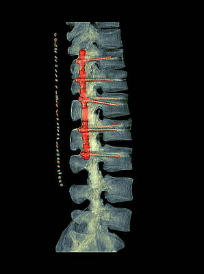 Wall Art - Photograph - Pinned Broken Spine #1 by Science Photo Library
