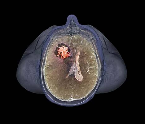 Wall Art - Photograph - Brain Tumour #2 by Science Photo Library
