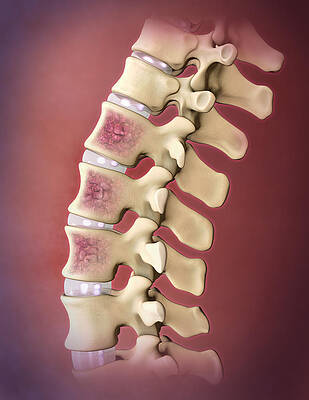 Wall Art - Photograph - Multiple Myeloma, Spine #2 by Evan Oto