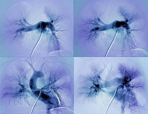 Wall Art - Photograph - Pulmonary Clot Causing A Heart Attack #2 by Science Photo Library