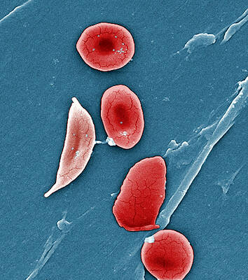 Wall Art - Photograph - Sickle Cell Anemia, Human Rbcs, Sem #2 by Science Source