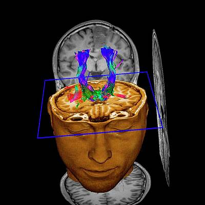 Wall Art - Photograph - Brain Tumour #3 by Science Photo Library