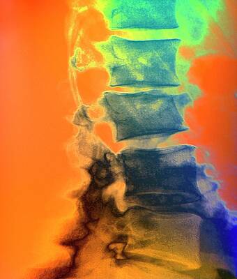 Wall Art - Photograph - Osteoporotic Spine #3 by Science Photo Library