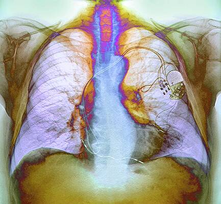 Wall Art - Photograph - Heart Pacemaker #4 by Science Photo Library