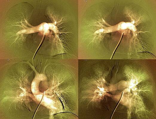 Wall Art - Photograph - Pulmonary Clot Causing A Heart Attack #5 by Science Photo Library