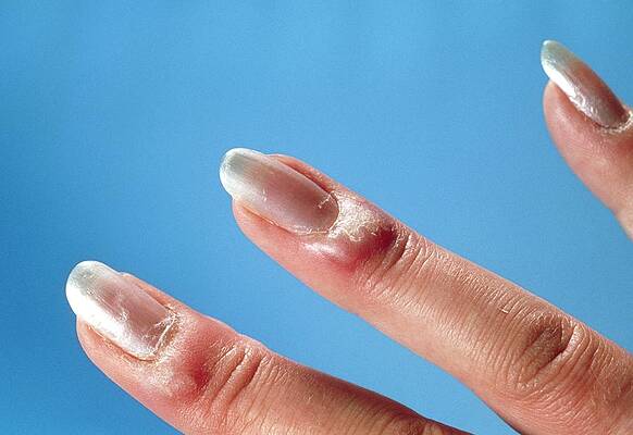 Wall Art - Photograph - Acute Paronychia On Fingers by Science Photo Library