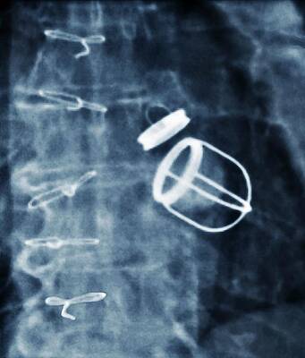 Wall Art - Photograph - Artificial Heart Valves by Science Photo Library