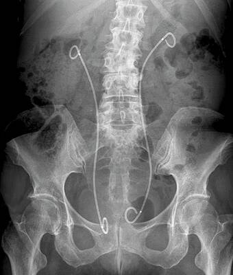 Wall Art - Photograph - 'artificial Kidney Ureters by Science Photo Library