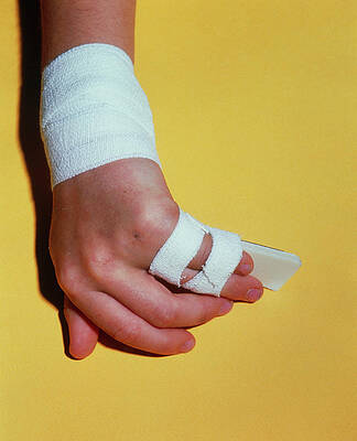 Wall Art - Photograph - Broken Little Finger Bandaged And Splinted by Science Photo Library