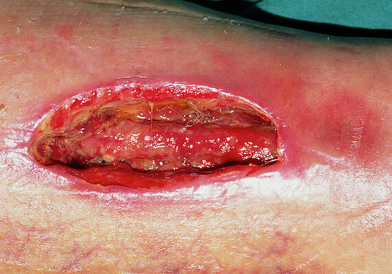 Wall Art - Photograph - Close Up Of An Open And Infected Leg Wound by Science Photo Library