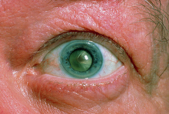 Wall Art - Photograph - Close-up Of Patient's Eye With Trauma Cataract by Science Photo Library
