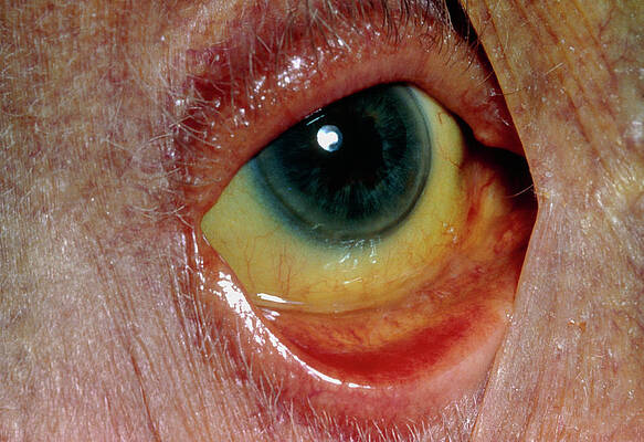 Wall Art - Photograph - Close-up Of Yellow Eyeball In Jaundice by Science Photo Library