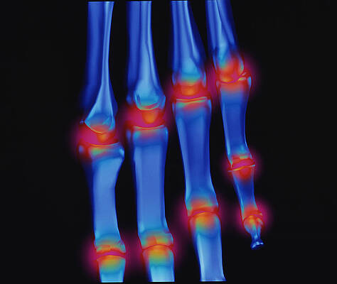 Wall Art - Photograph - Computer Artwork Of Arthritis Affecting Fingers by Science Photo Library