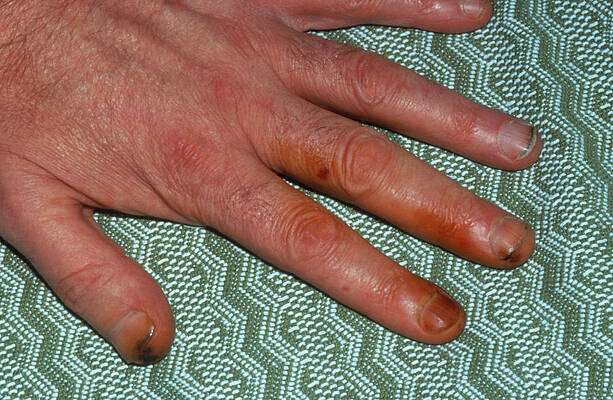 Wall Art - Photograph - Hand With Tar Stains From Cigarette Smoking by Science Photo Library