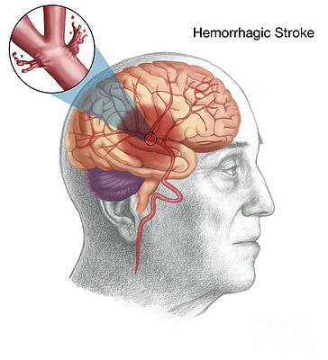 Wall Art - Photograph - Hemorrhagic Stroke by Spencer Sutton
