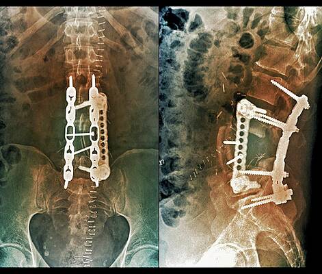 Wall Art - Photograph - Implants Following Spinal Surgery by Science Photo Library