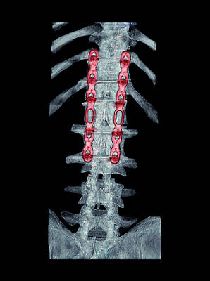 Wall Art - Photograph - Pinned Broken Spine by Science Photo Library