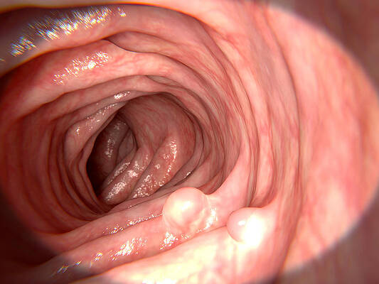 Wall Art - Photograph - Polyps In The Intestine by Juan Gaertner