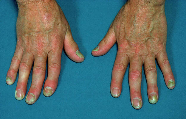 Wall Art - Photograph - Psoriasis Affecting The Fingers by Science Photo Library