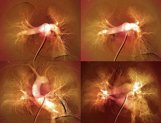 Wall Art - Photograph - Pulmonary Clot Causing A Heart Attack by Science Photo Library