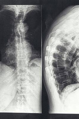 Wall Art - Photograph - Spinal Compression Fracture by Science Photo Library