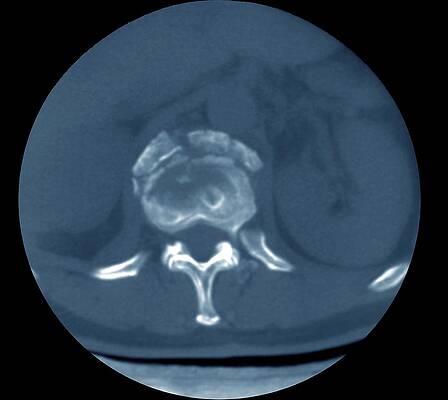 Wall Art - Photograph - Spine Fracture Bone Fragments by Science Photo Library