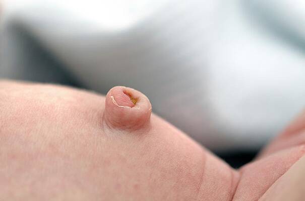 Wall Art - Photograph - Two Week Old Baby's Belly Button by Science Photo Library