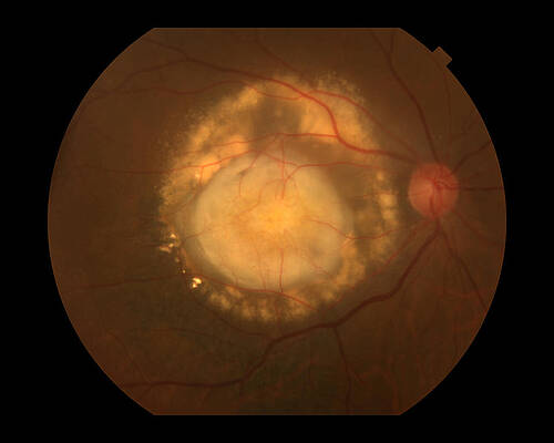 Wall Art - Photograph - Wet Age-related Macular Degeneration by Paul Whitten